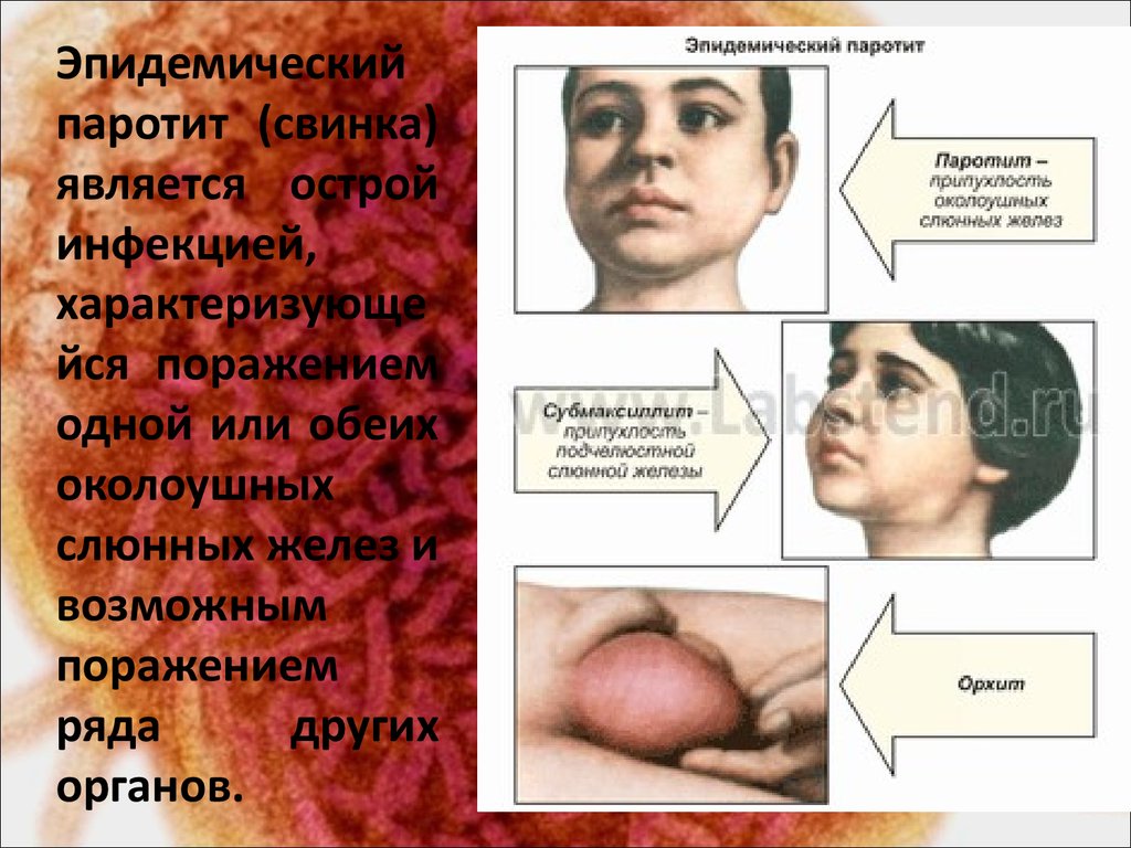 Свинка или эпидемический паротит. что делать, если у ребенка паротит?