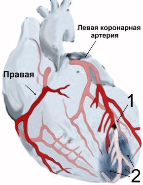 Смерть от инфаркта – типы, симптомы, признаки