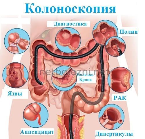 Слабительное средство "пикопреп": отзывы, инструкция по применению, аналоги