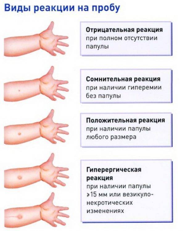 Реакция манту: польза или вред?