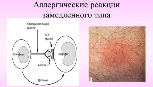 Все об аллергии на сладкое. симптомы, признаки, лечение заболевания
