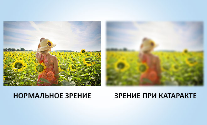 Кто вылечил катаракту народными средствами