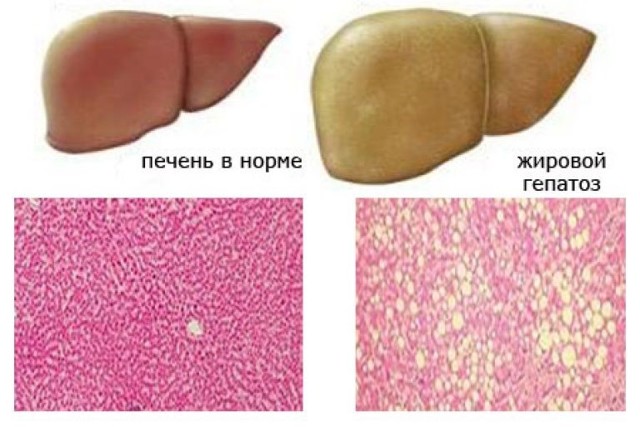 Диета при гепатозе печени