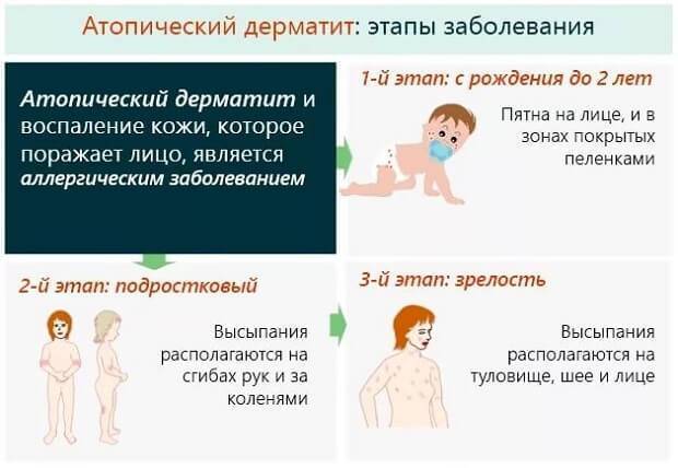 Сыпь на животе у взрослого человека: причины, симптомы, диагностика и лечение