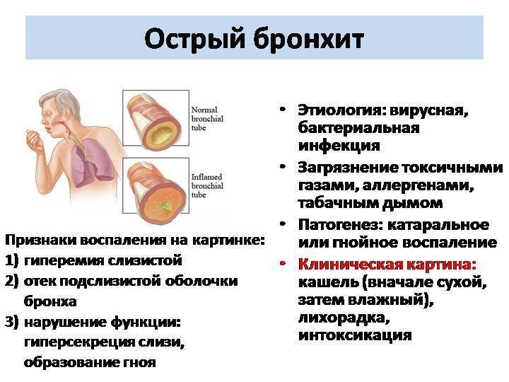 Бронхит у взрослых и детей: признаки, симптомы, лечение острого бронхита. как лечить бронхит в домашних условиях
