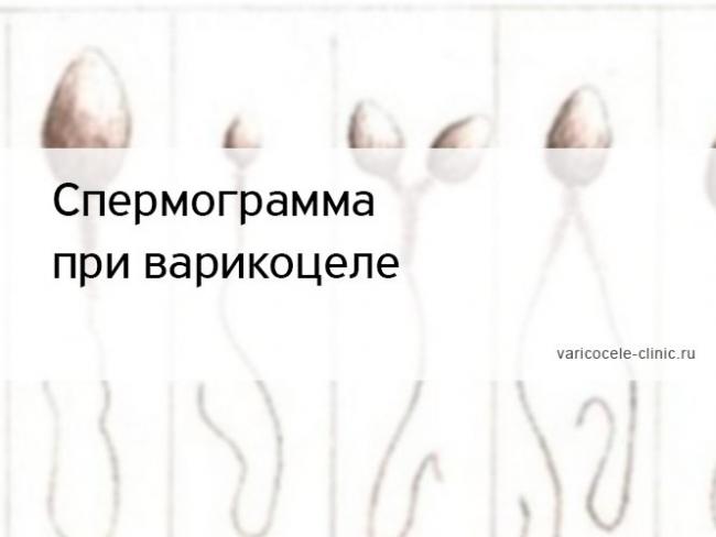 Может ли варикоцеле стать причиной бесплодия