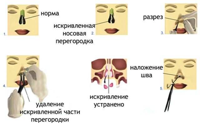 Как исправить деформацию носовой перегородки без операции