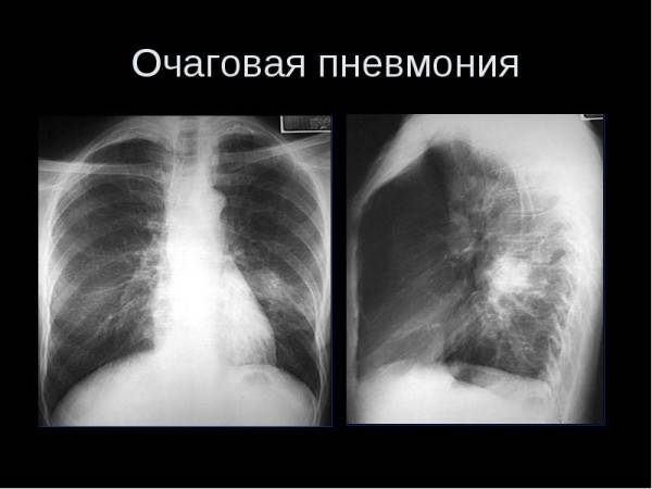Как отличить по кашлю бронхит от пневмонии