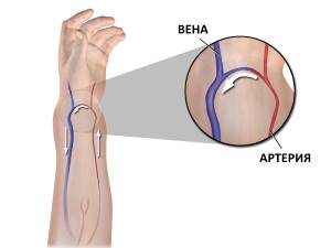 Артериовенозная фистула - dural arteriovenous fistula - qwe.wiki