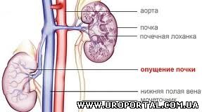 Нефроптоз почки - что это такое? симптомы и лечение заболевания