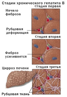 Диета для хронического гепатита с