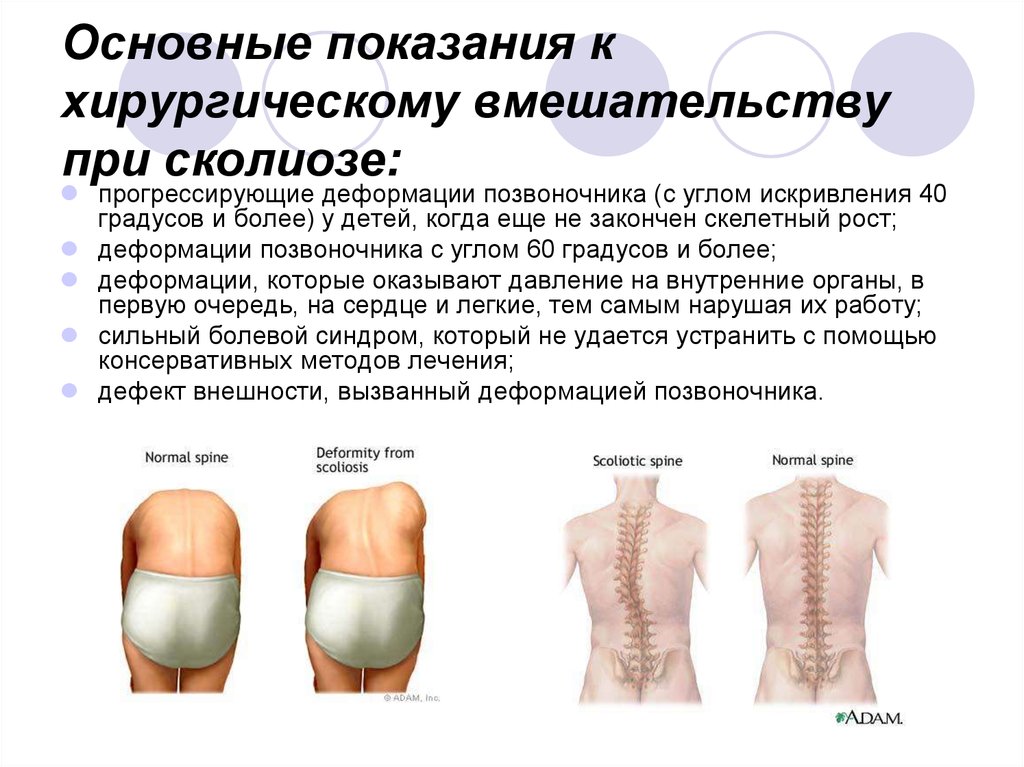 Лечение сколиоза первой степени