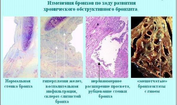 Хобл: классификация по степени тяжести, этиология, патогенез, диагностика, лечение, 2, 4, как долго можно прожить