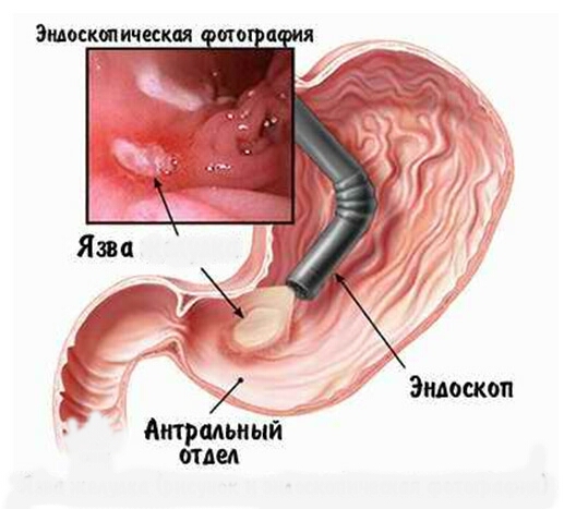 Что такое рефлюкс эзофагит: симптомы и причины, диагностика и лечение, профилактика