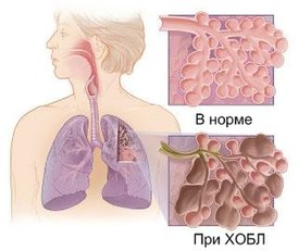 Классификация хобл: определение, стадии и типы, степени тяжести, лечение