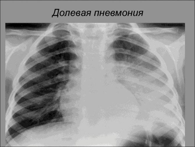 Левосторонняя пневмония: что это и сколько лечится у взрослых и детей