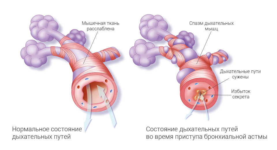 Причины и механизм развития приступа астмы, симптомы, первая помощь, лечение