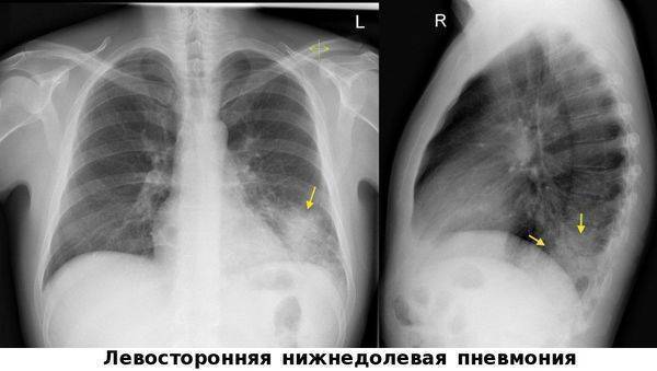Острая пневмония