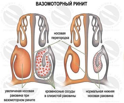 Лечение вазомоторного ринита в домашних условиях