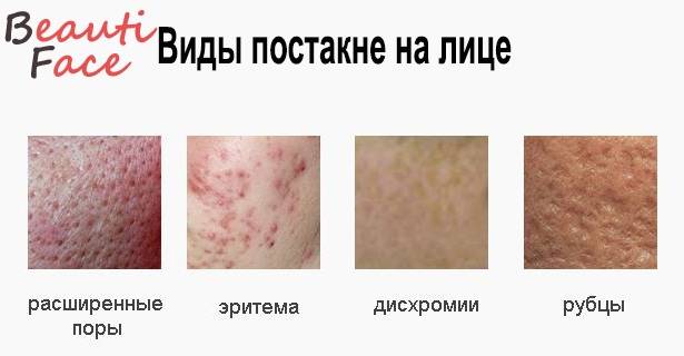 Лечение рубцов, как убрать рубцы на коже, удаление рубцов и шрамов