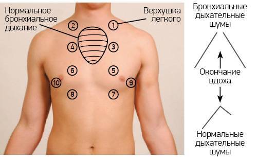 Особенности развития и течения острого бронхита у взрослых, методы лечения и профилактики