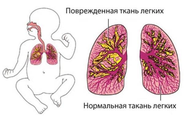 Как отличить бронхит от пневмонии: отличия в симптомах, причинах развития, разный подход к лечению