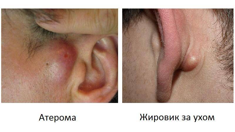 Воспаление лимфоузла перед ухом причины