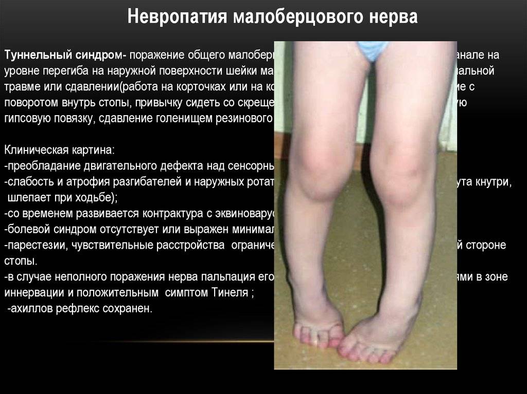 Как распознать и вылечить нейропатию малоберцового нерва