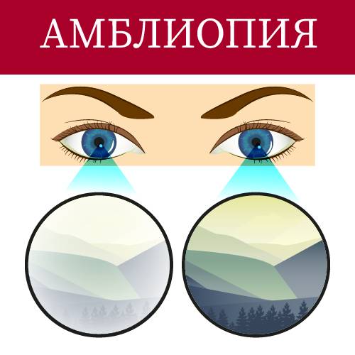 Как вылечить амблиопию у взрослого