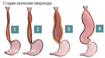 Ахалазия кардии