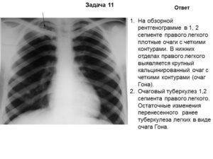 Инфильтративный туберкулез левого и правого легкого: лечение и дифференциальная диагностика