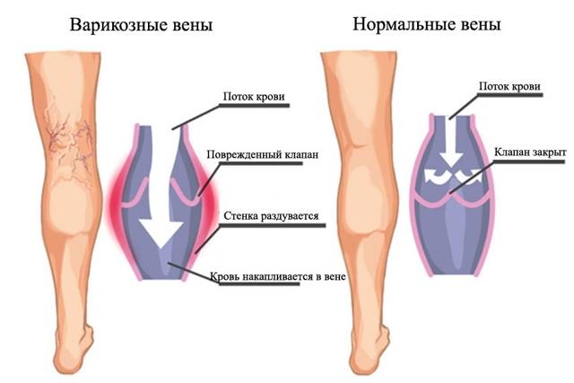 Осложнения на ноги у ребенка после орви