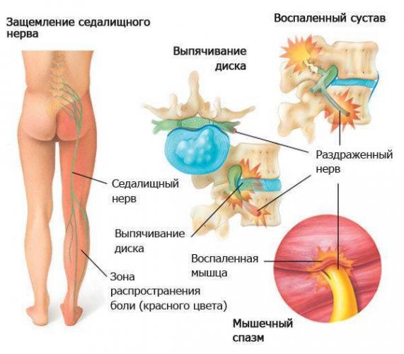 Как называется врач вправляющий позвоночник