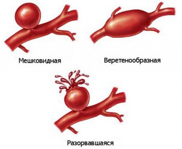 Как лечить окклюзию артерий нижних конечностей
