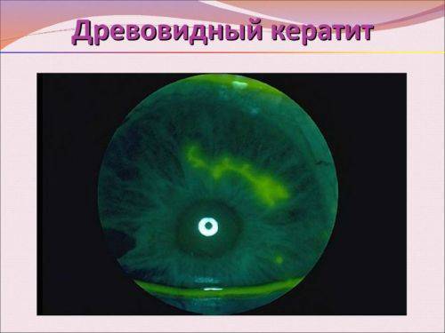 Воспаление глаза роговицы: причины, симптомы, лечение