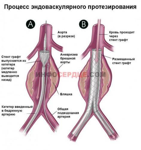 Аневризма брюшного отдела аорты: причины, симптомы, лечение