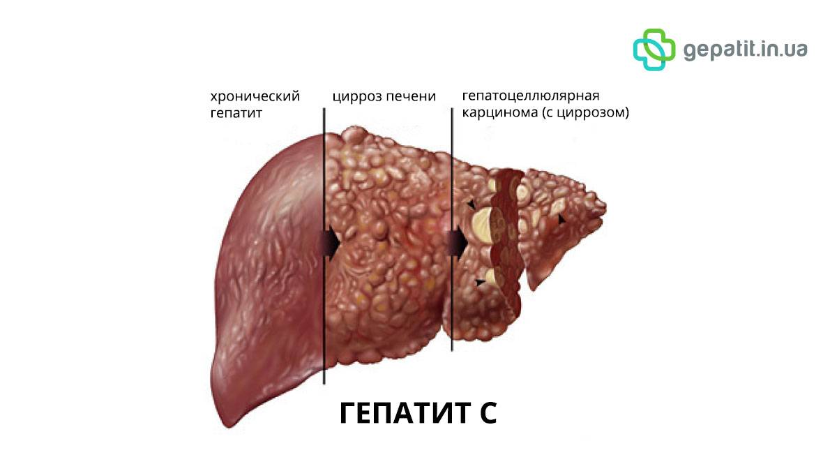 Хронический гепатит с очистка печени