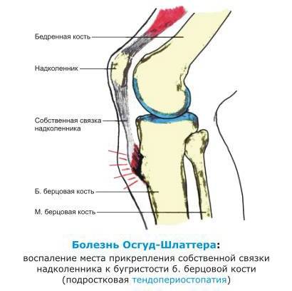 Болезнь шляттера