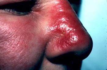 Streptococcus pyogenes (пиогенный стрептококк): особенности, патогенность, лечение