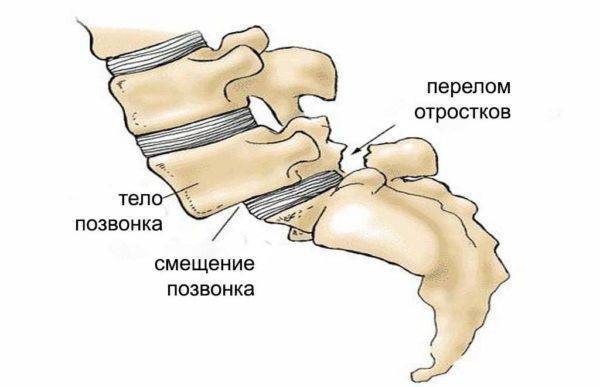Грыжа крестцового и копчикового отдела позвоночника