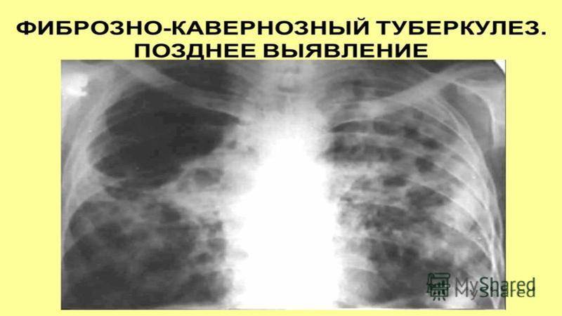 Фиброзно-кавернозный туберкулез