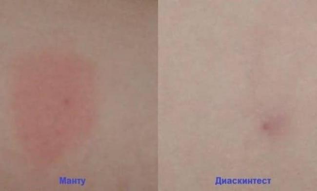 Что делать при аллергии на диаскинтест