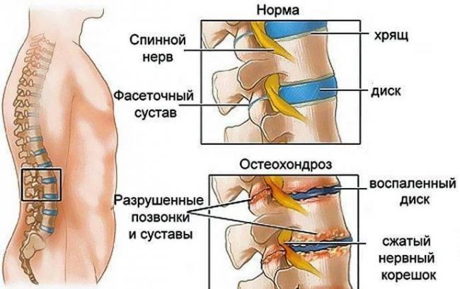 При остеохондрозе тахикардия