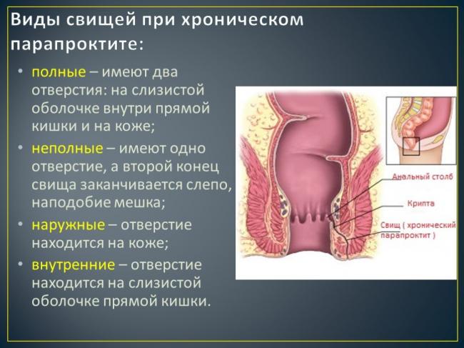 Парапроктит: причины, симптомы, диагностика и лечение