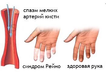 Каковы причины и симптомы болезни рейно