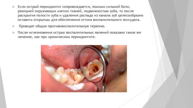 Пульпит острый и хронический. причины, симптомы, диагностика, осложнения и лечение пульпита. виды пульпита: фибринозный, гангренозный, гнойный, гипертрофический.
