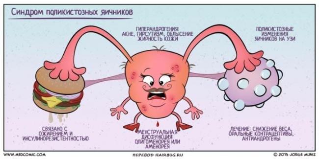 Синдром поликистозных яичников