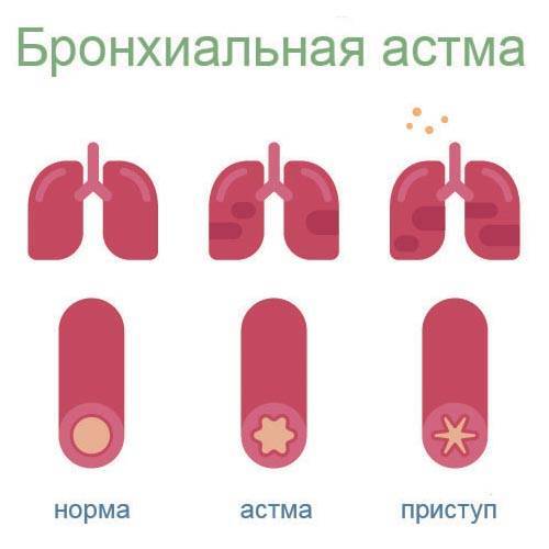 Одышка при бронхиальной астме. ингалятор не панацея – он не лечит!