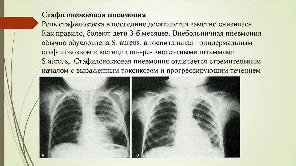 Стафилококковая пневмония | eurolab | пульмонология