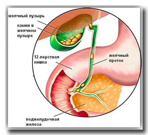 Желчекаменная болезнь. причины, симптомы, классификация и осложнения